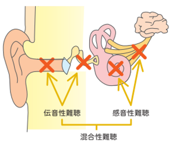 難聴の種類